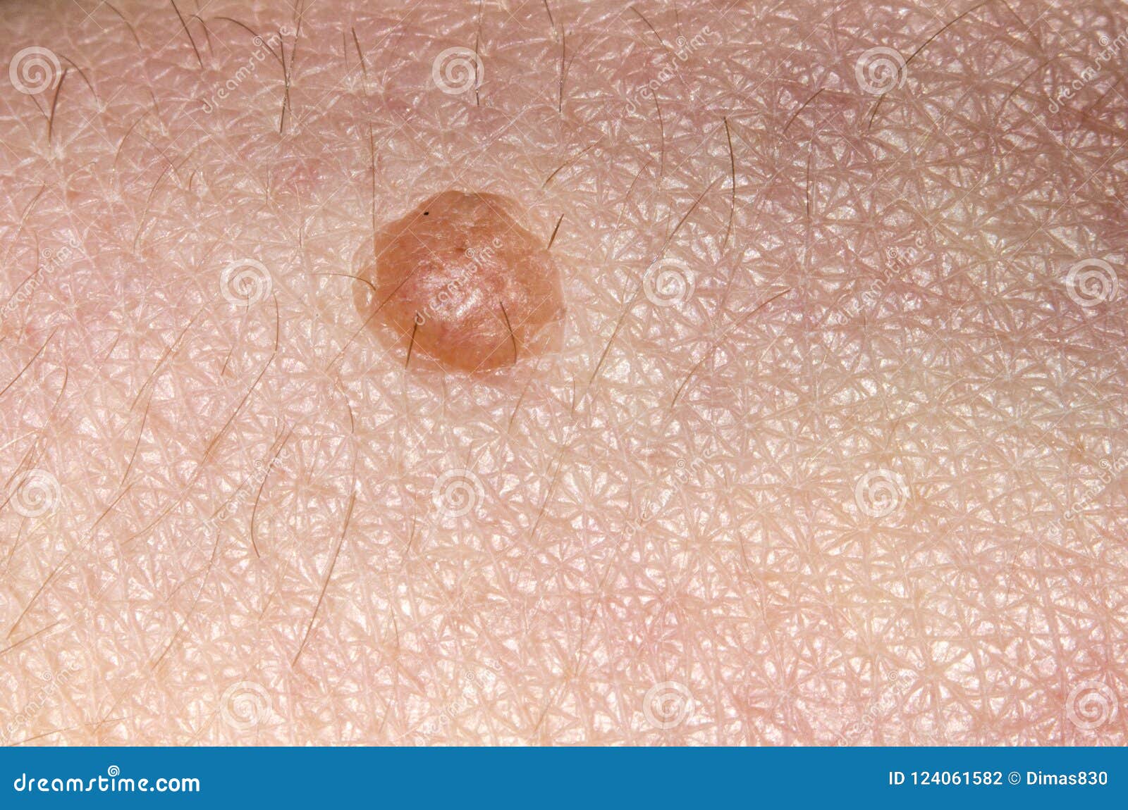 papilloma skin benign