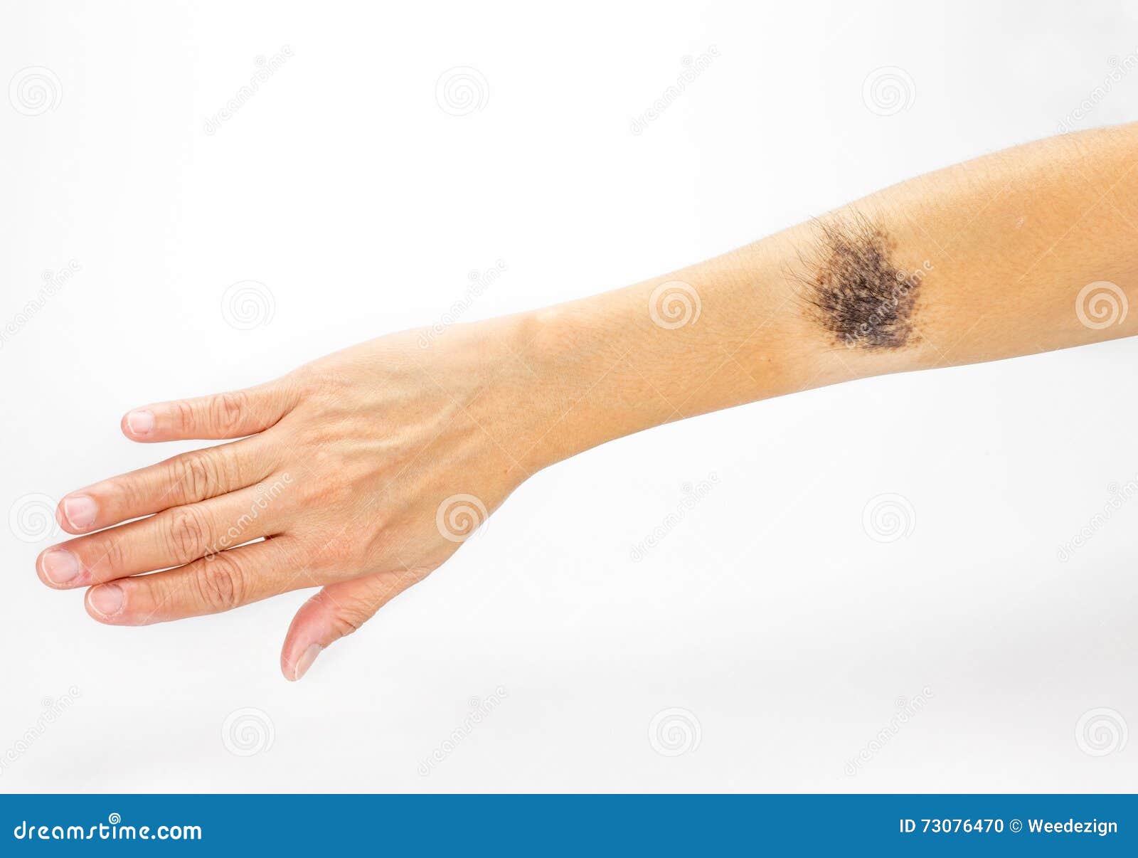 black birthmark on arm on white background