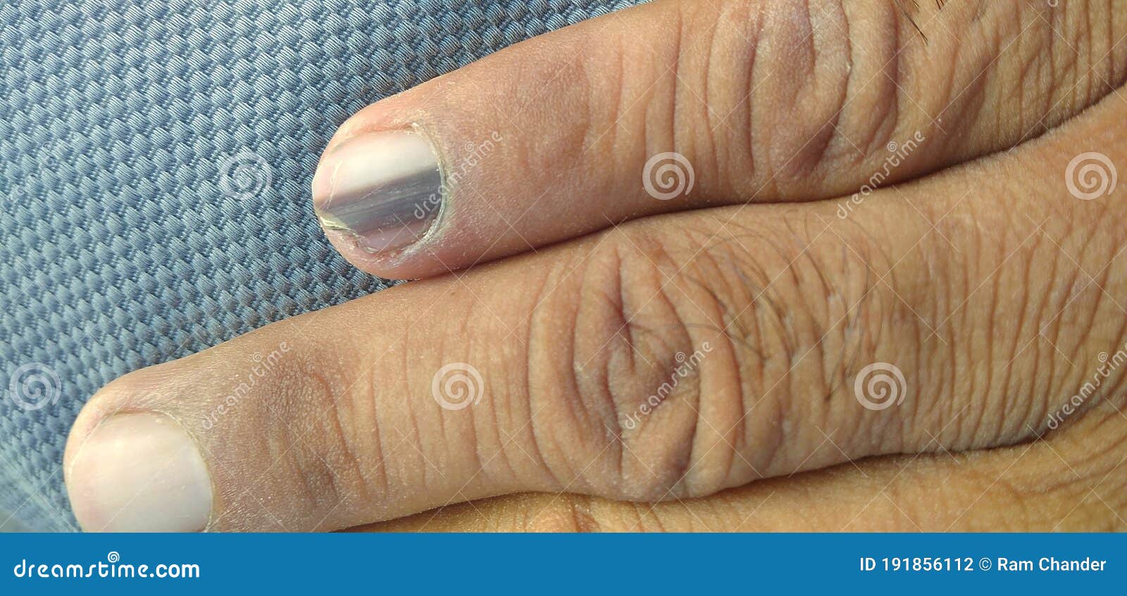 Black Line on Nails. Subungual Melanoma. Stock Photo - Image of care, line:  191856112