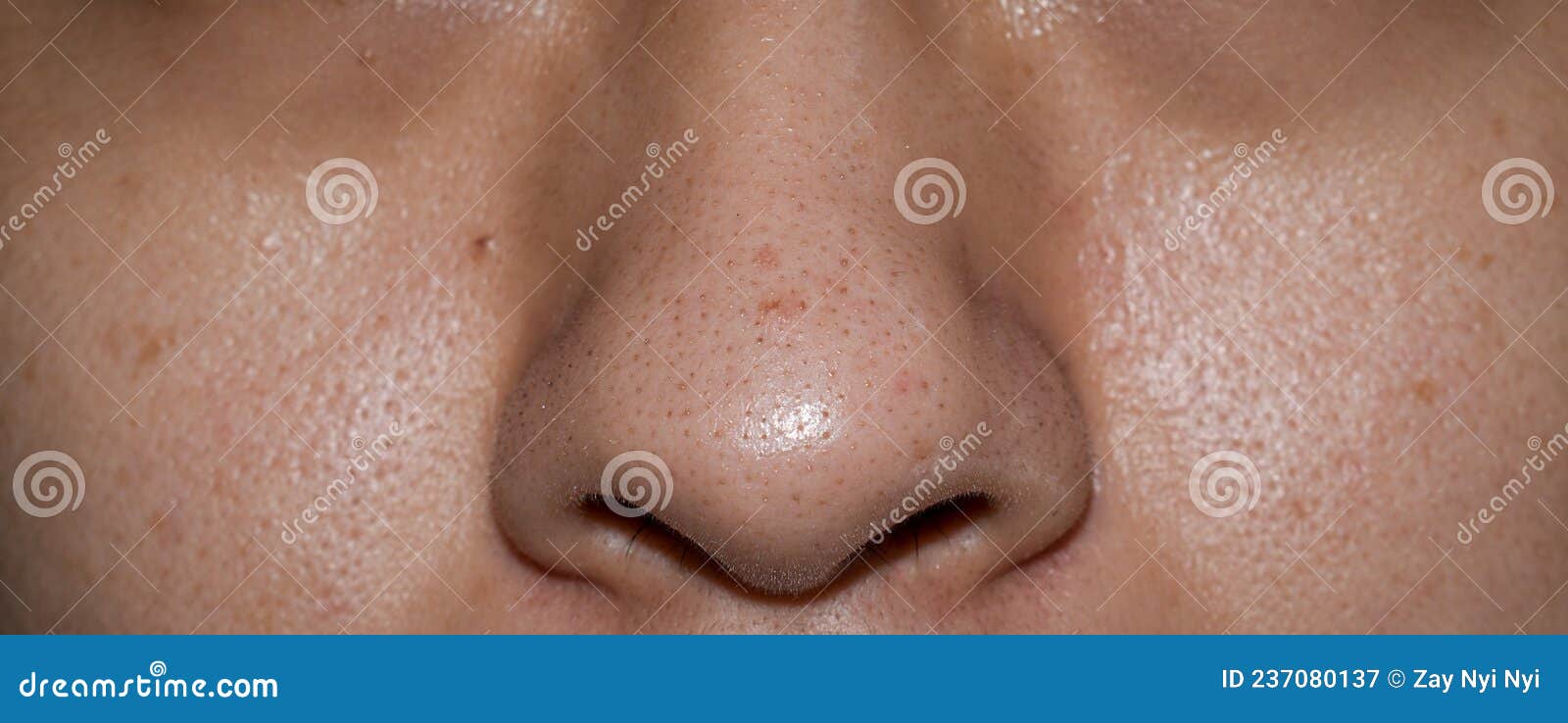 Blackheads or Black Heads on Nose of Asian Man Stock Image - Image of  asian, dark: 237080137