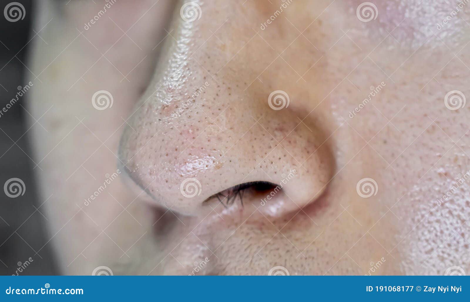 Blackheads or Black Heads on Nose of Asian Man Stock Image - Image of male,  dark: 191068177