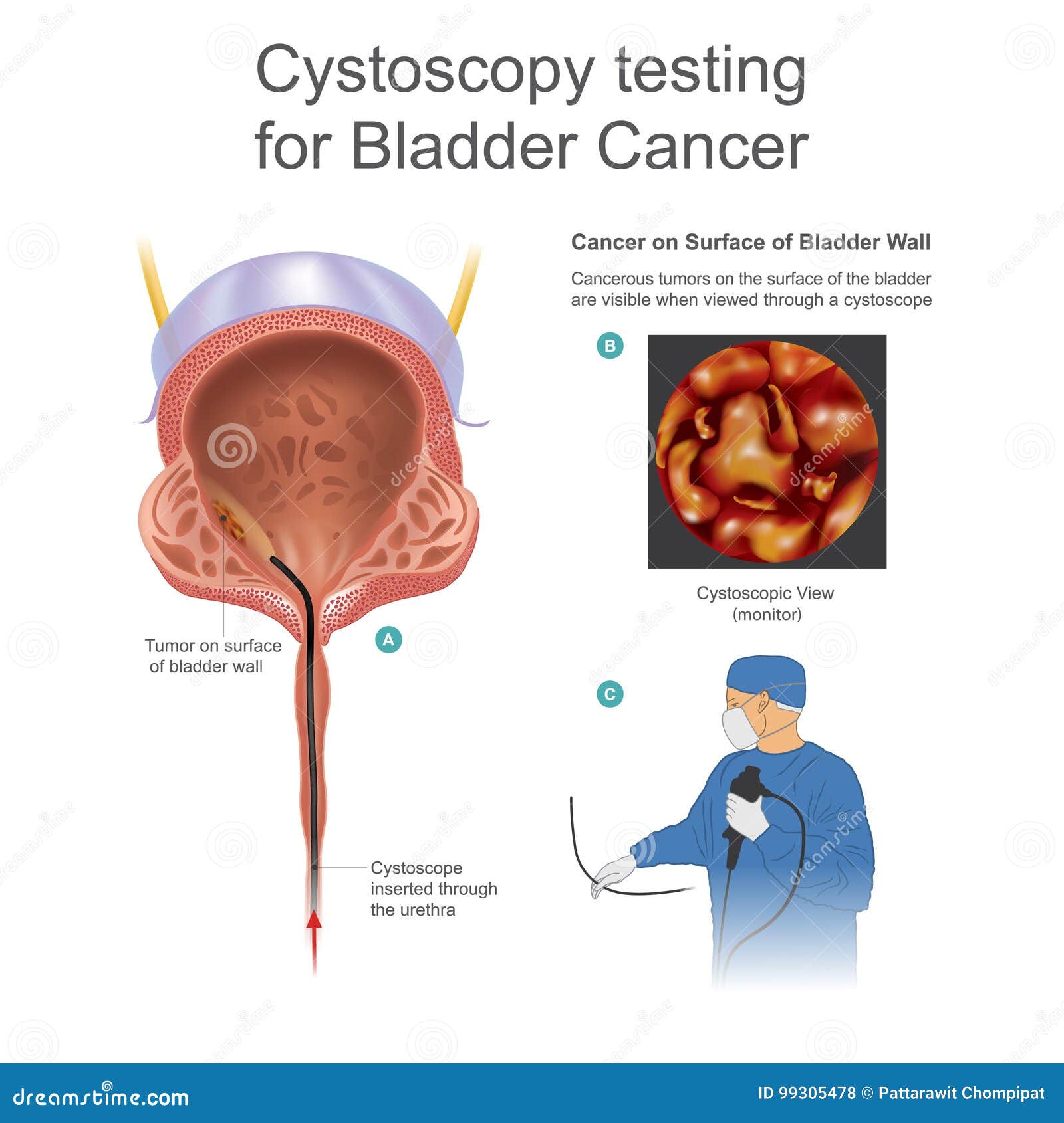 The Types Of Urinary Catheters Vector Illustration