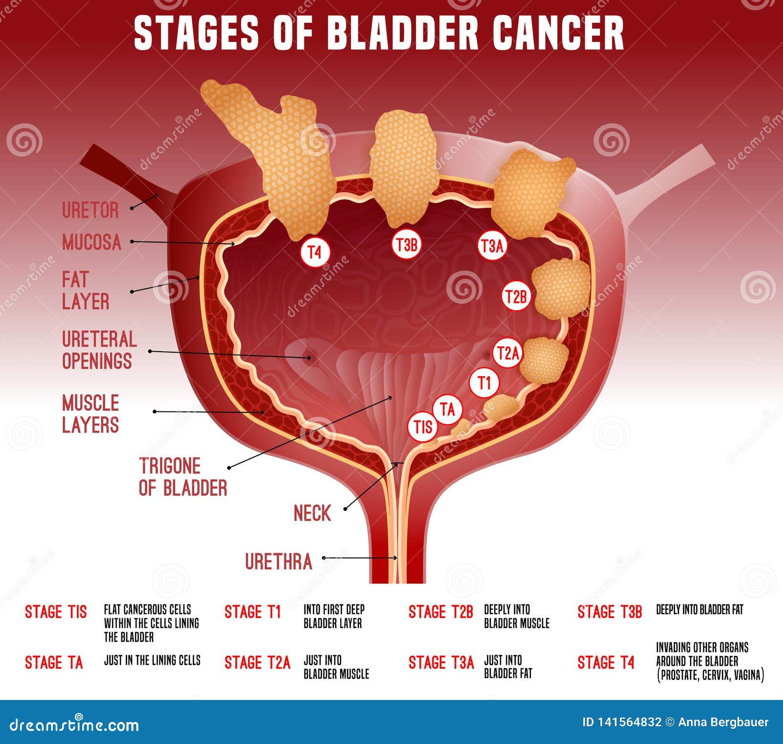 bladder cancer image