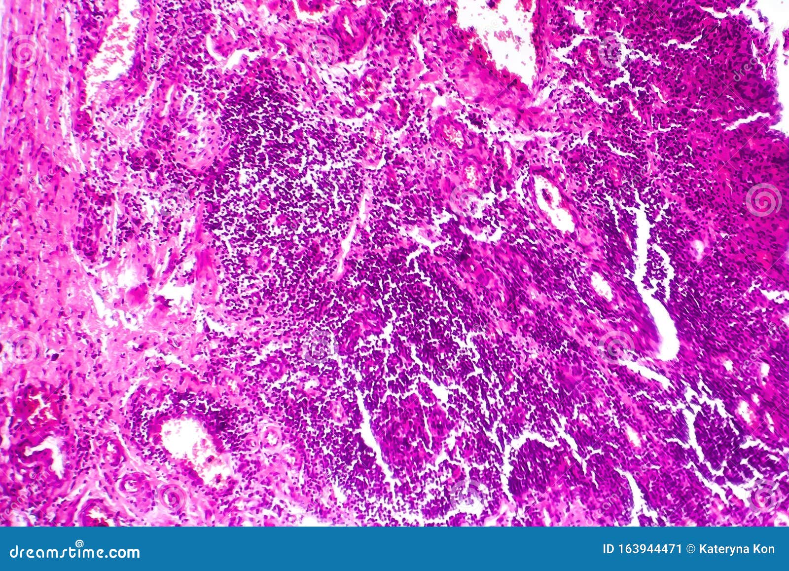 Bladder Cancer, Light Micrograph Stock Image Image of medicine
