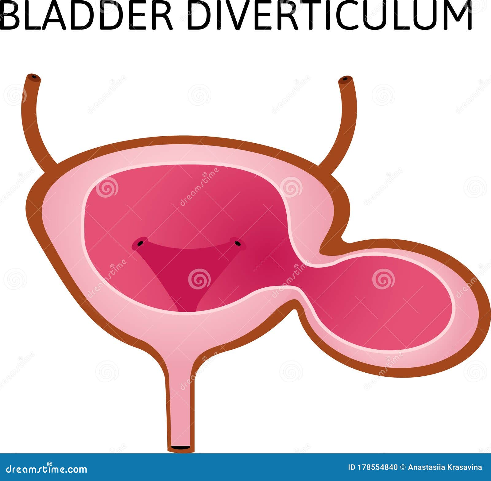 Diverticulum Cartoons Illustrations Vector Stock Images 72 diverticulum-cartoons-illustrations-vector-stock-images-72