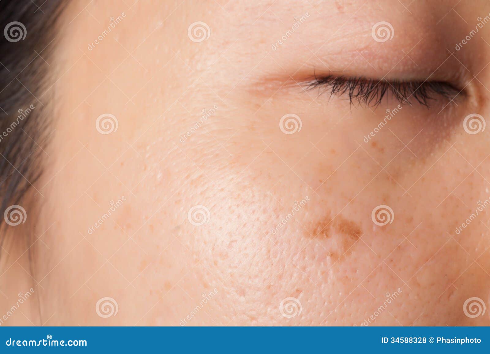 blemish and spots