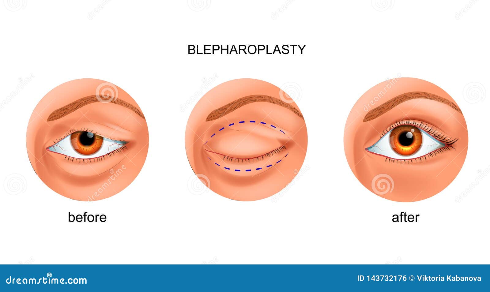 blepharoplasty of the overhanging eyelid