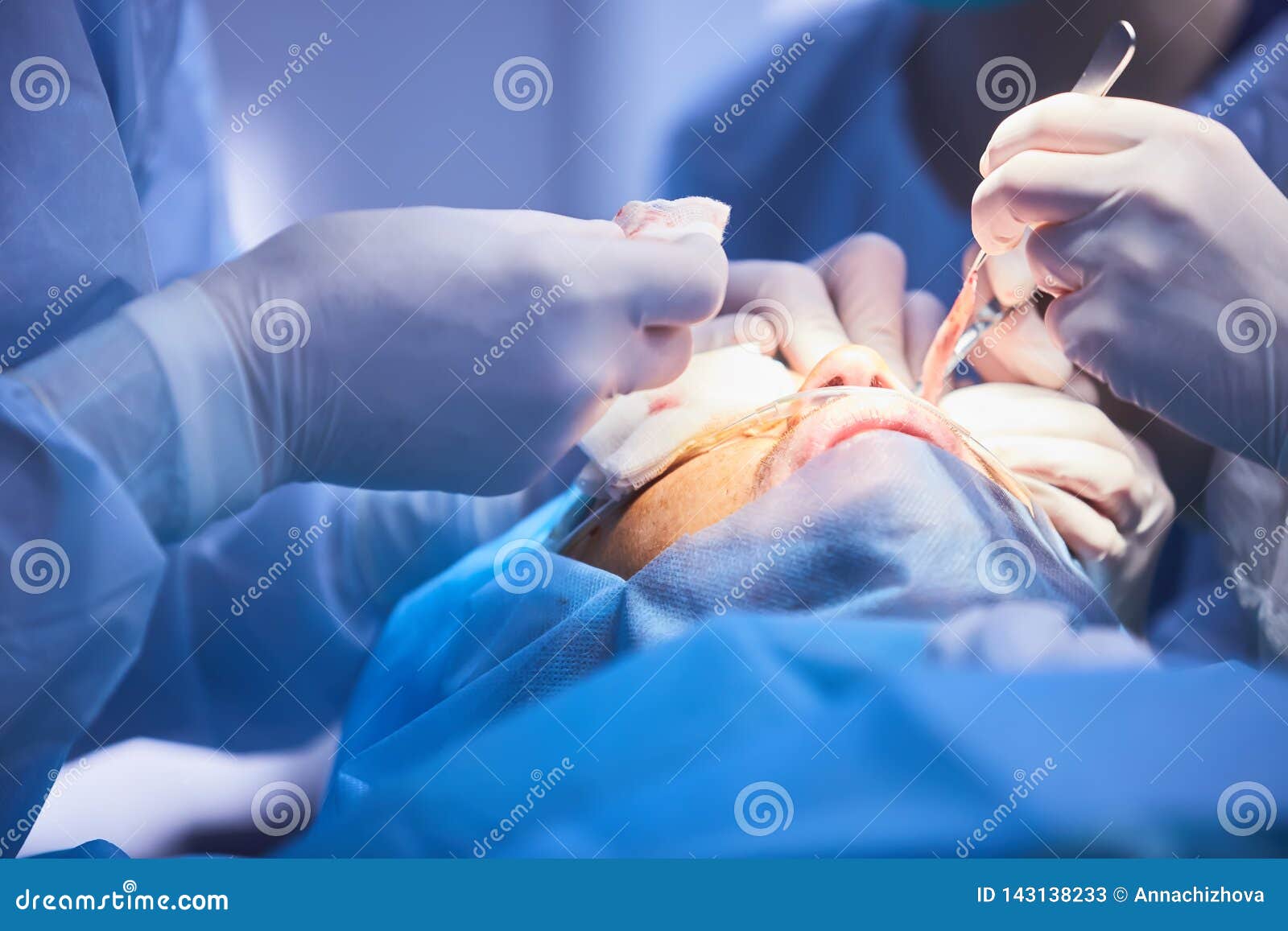 Blepharoplasty, Plastic Surgery Operation for Correcting Defects