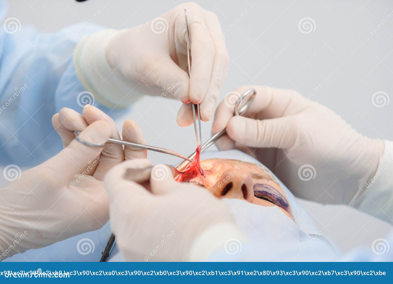 Blepharoplasty, Plastic Surgery Operation for Correcting Defects