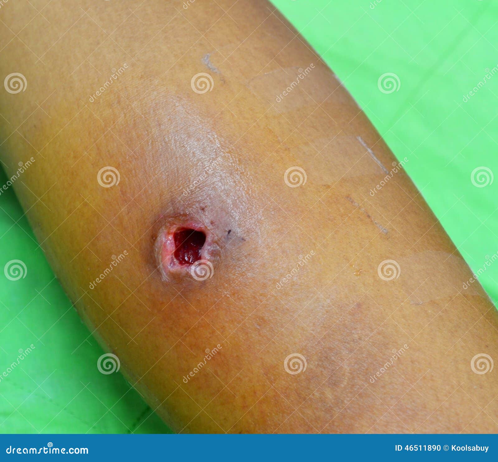 Blessure d'abcès photo stock. Image du inflammation, patte - 46511890