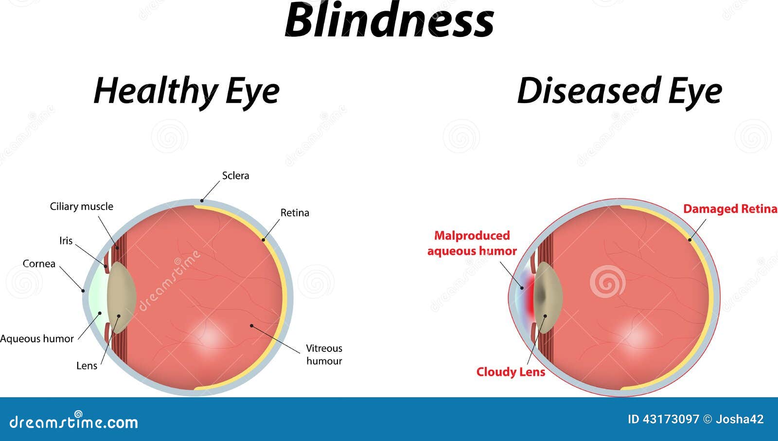 Blindness Stock Vector  Illustration Of Syndrome  Visual