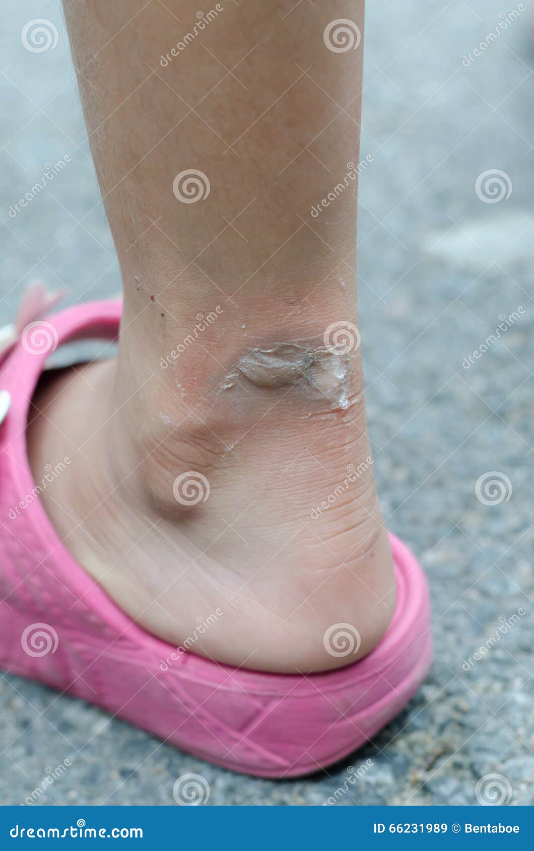 Blister on ankle stock image. Image of healthcare, burn 66231989