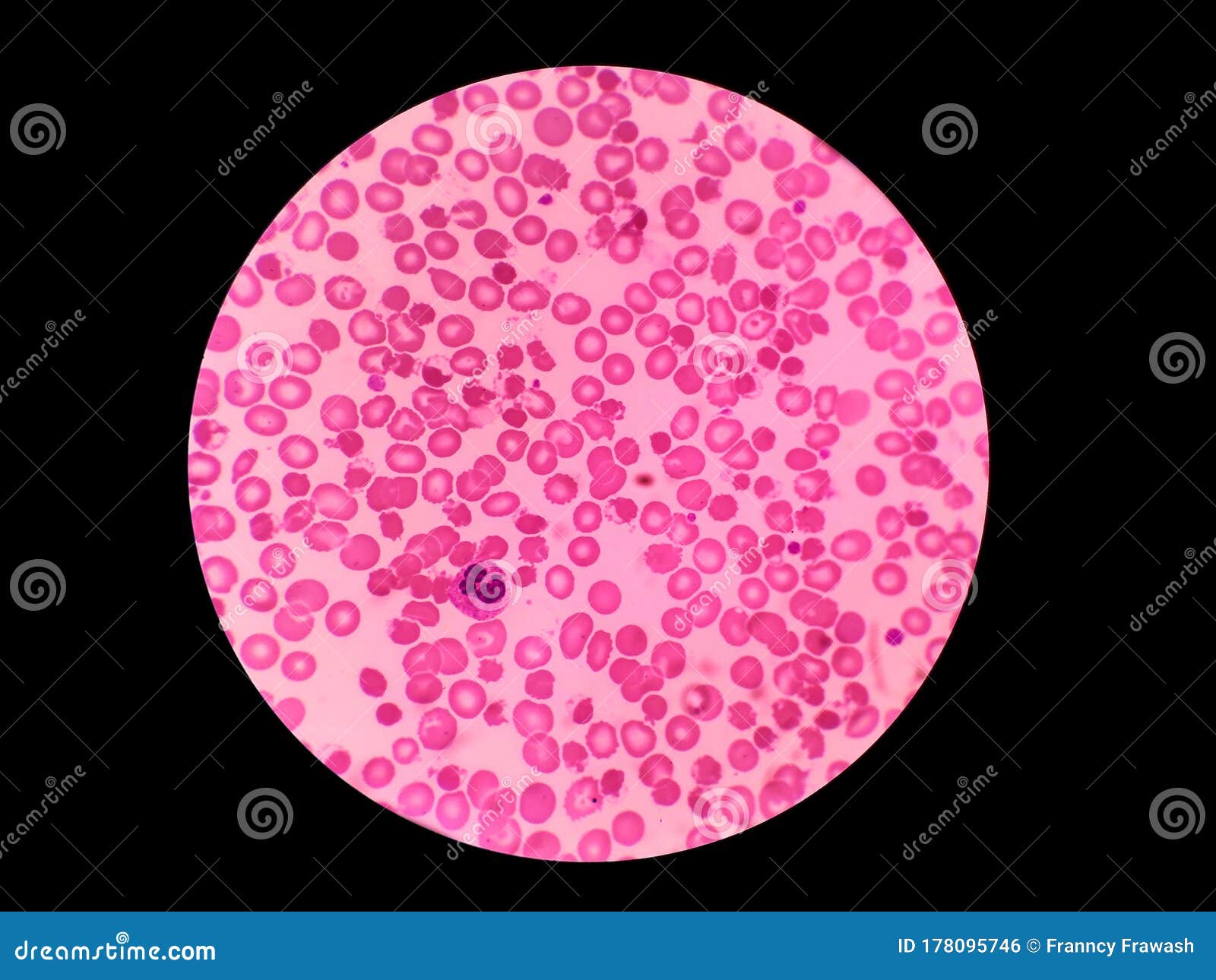 Blister Cell Blood Test Red Blood Cells Stock Photo Image Of