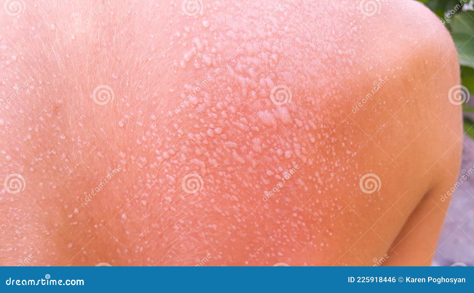 Blisters on the Back from Sunburn. a Young Guy on Vacation at the Beach