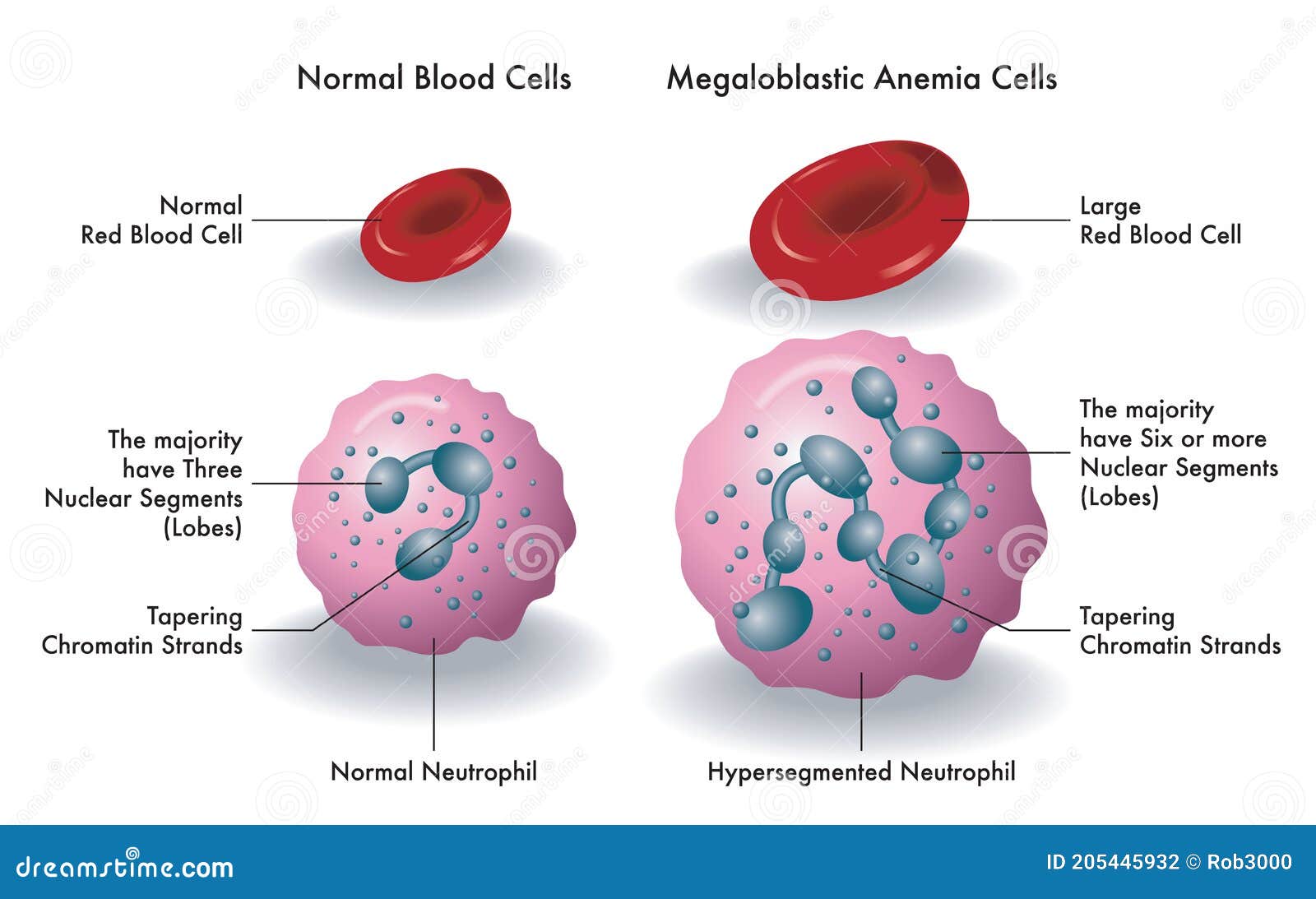 blood cells with megaloblastic anemia 