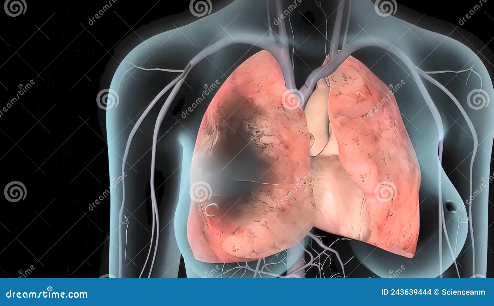 Blood clot in the lung stock illustration. Illustration of healthy