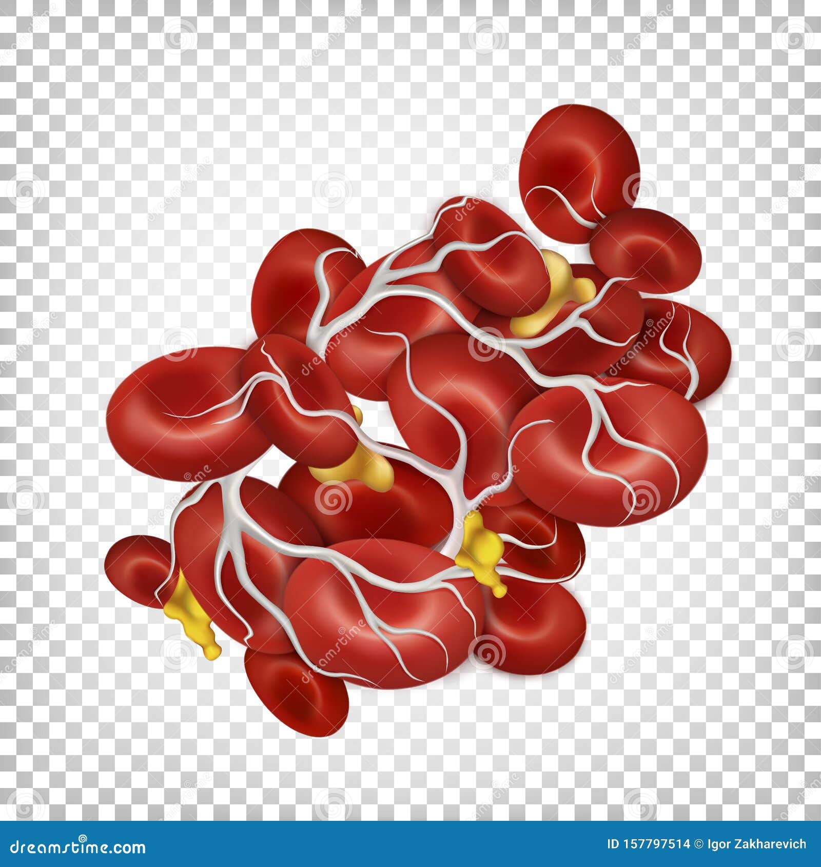 blood clot. thrombus. red blood cells bound by fibrin filaments.