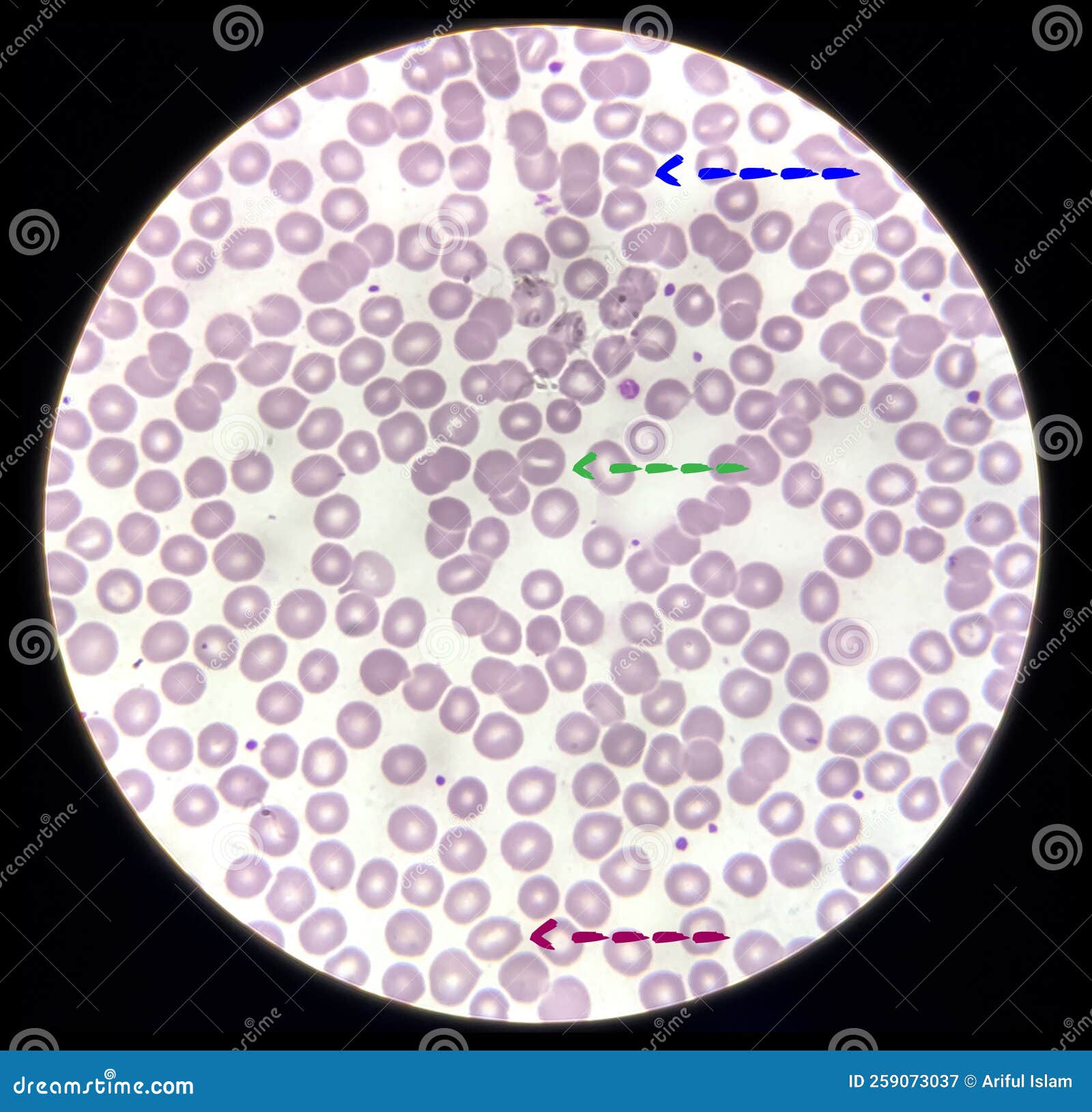 blood film microscopic show decrease platelets leucocyte (wbc).