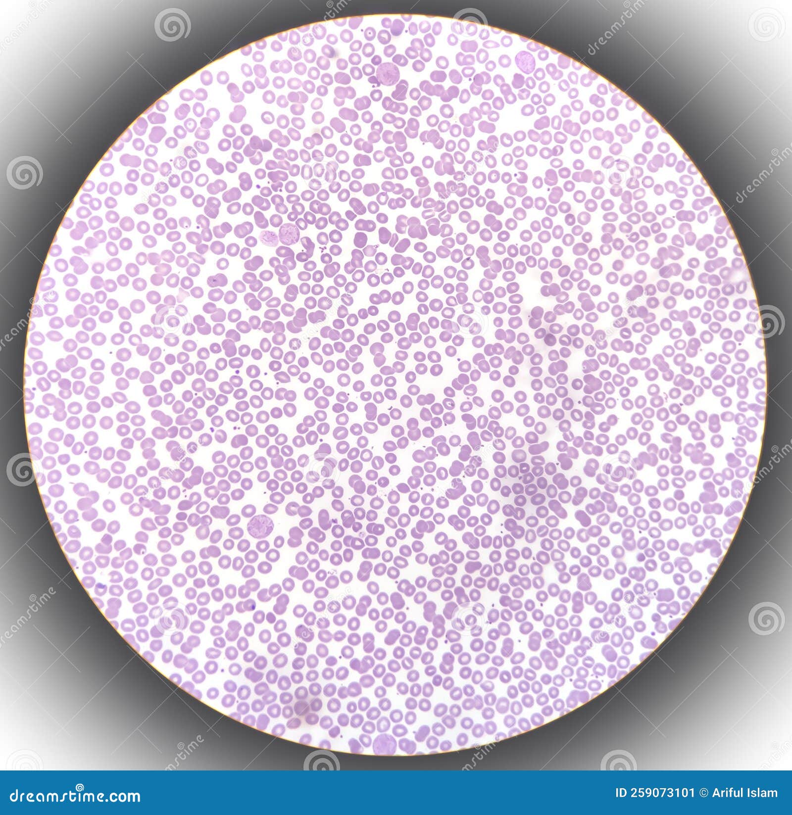 blood film showing a decrease of platelets