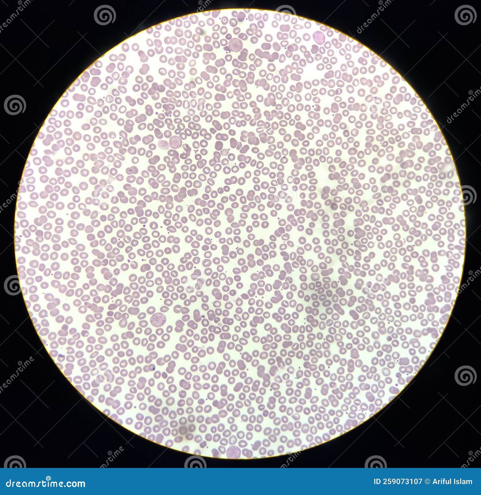 blood film showing a decrease of platelets and white blood cells. immune thrombocytopenic purpura (itp)