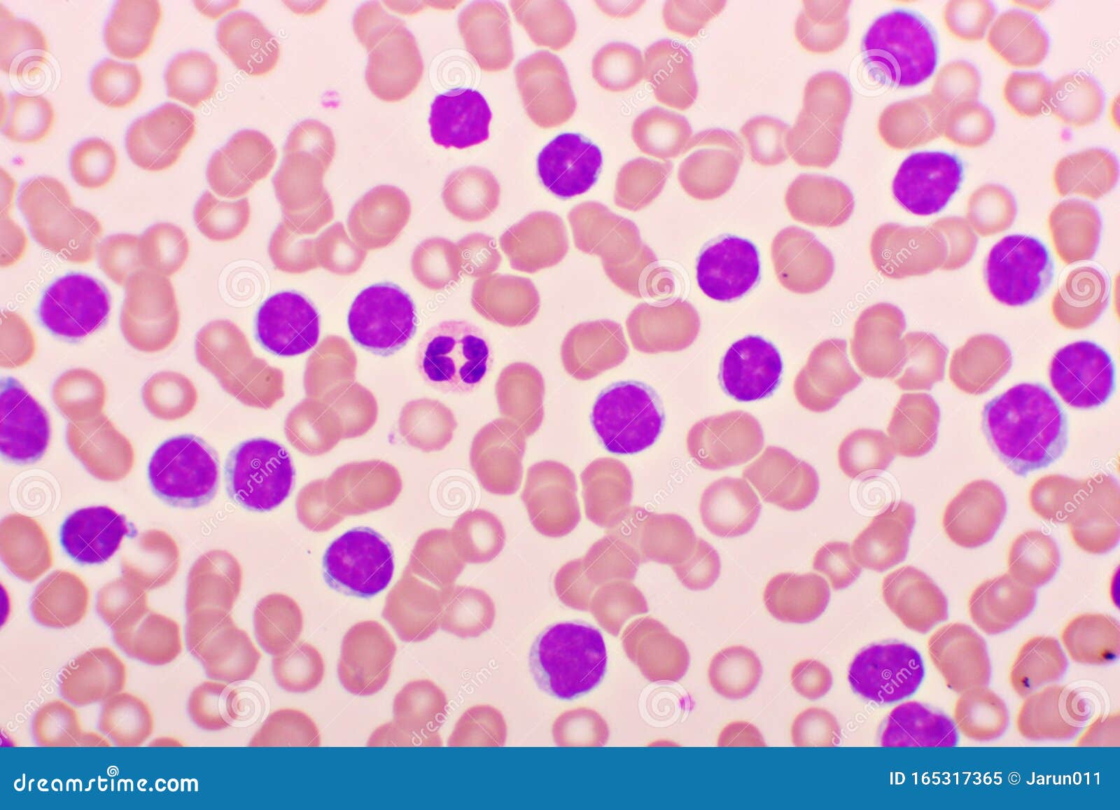 Blood Picture Of Chronic Lymphocytic Leukemia Or CLL Stock Image