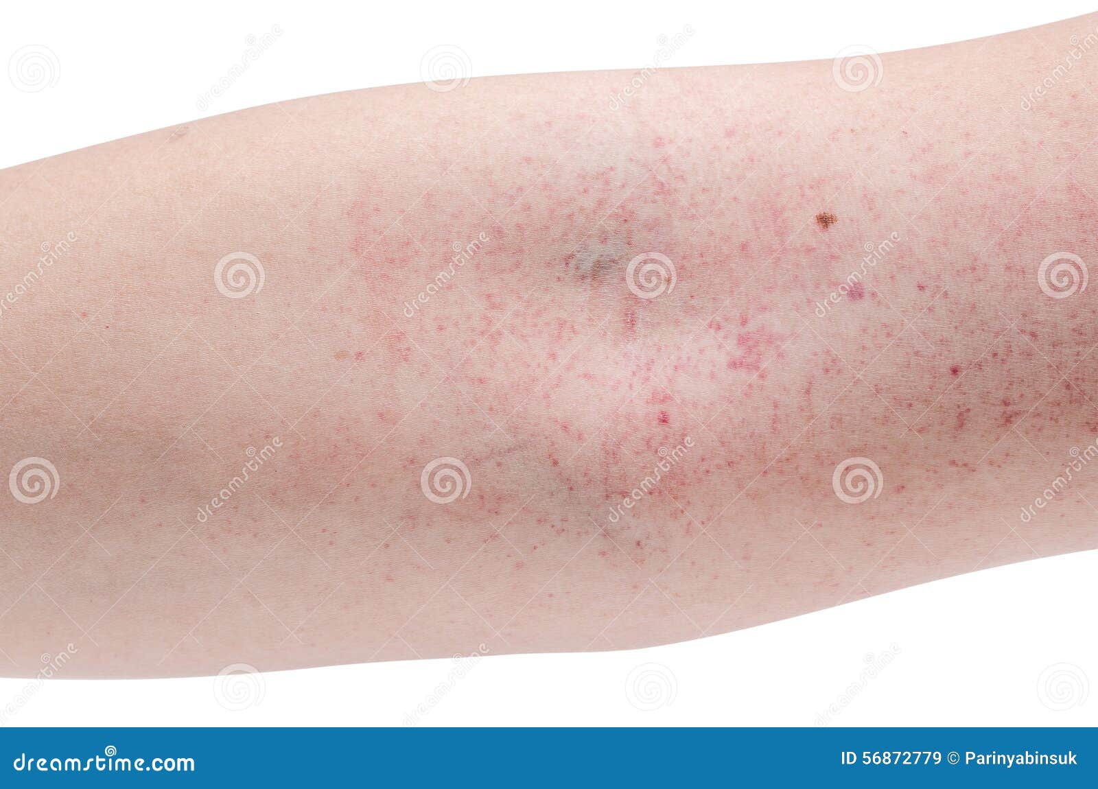 Blood rush at arm stock image. Image of skin, sickness 56872779