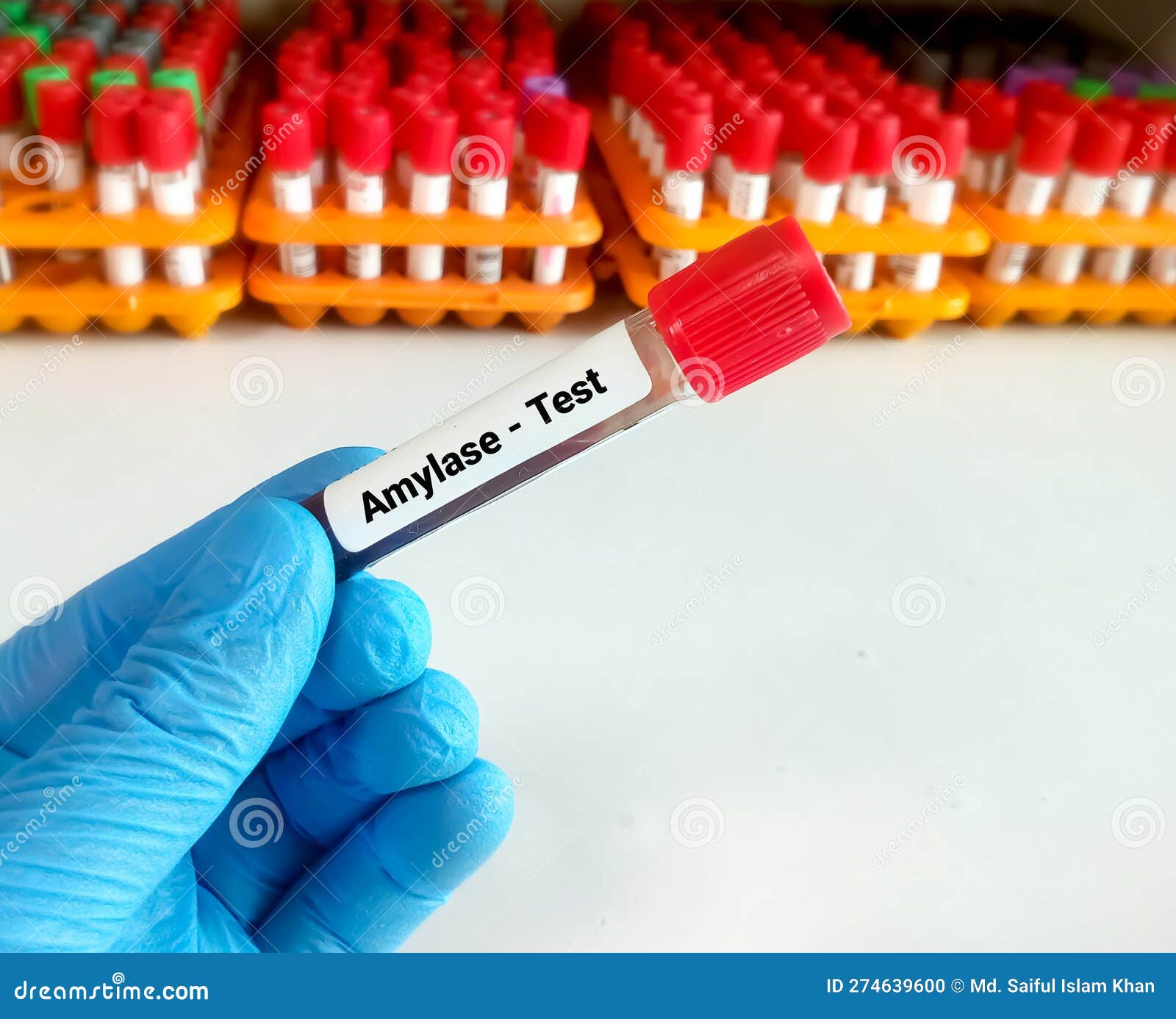 Blood Sample for Amylase Enzyme Test. Diagnosis of Pancreatitis Stock Blood Sample for Amylase Enzyme Test. Diagnosis of Pancreatitis Stock