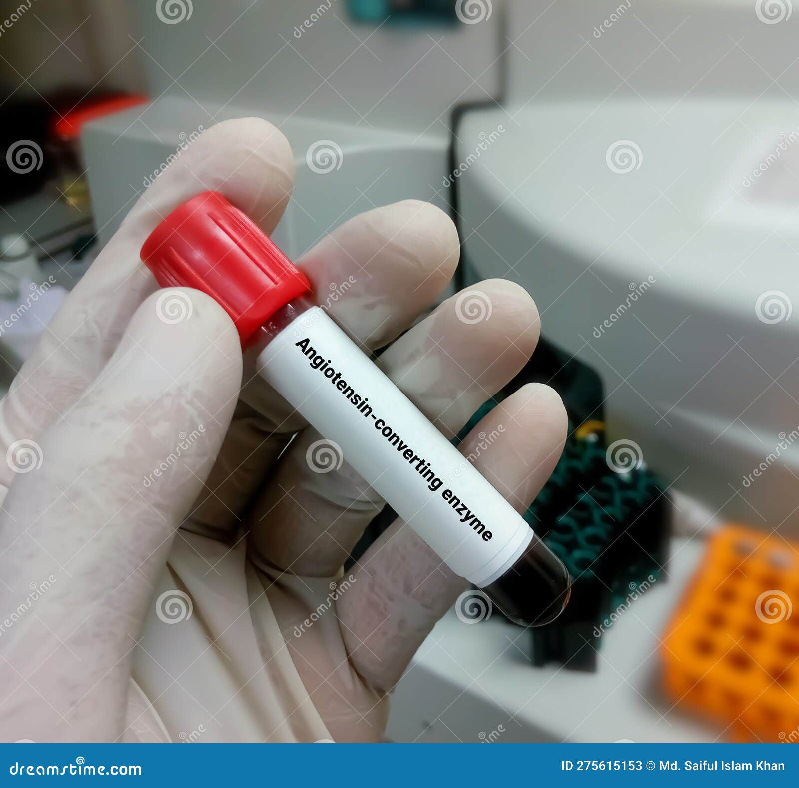 Blood Sample for Angiotensinconverting Enzyme (ACE) Test. Stock Image