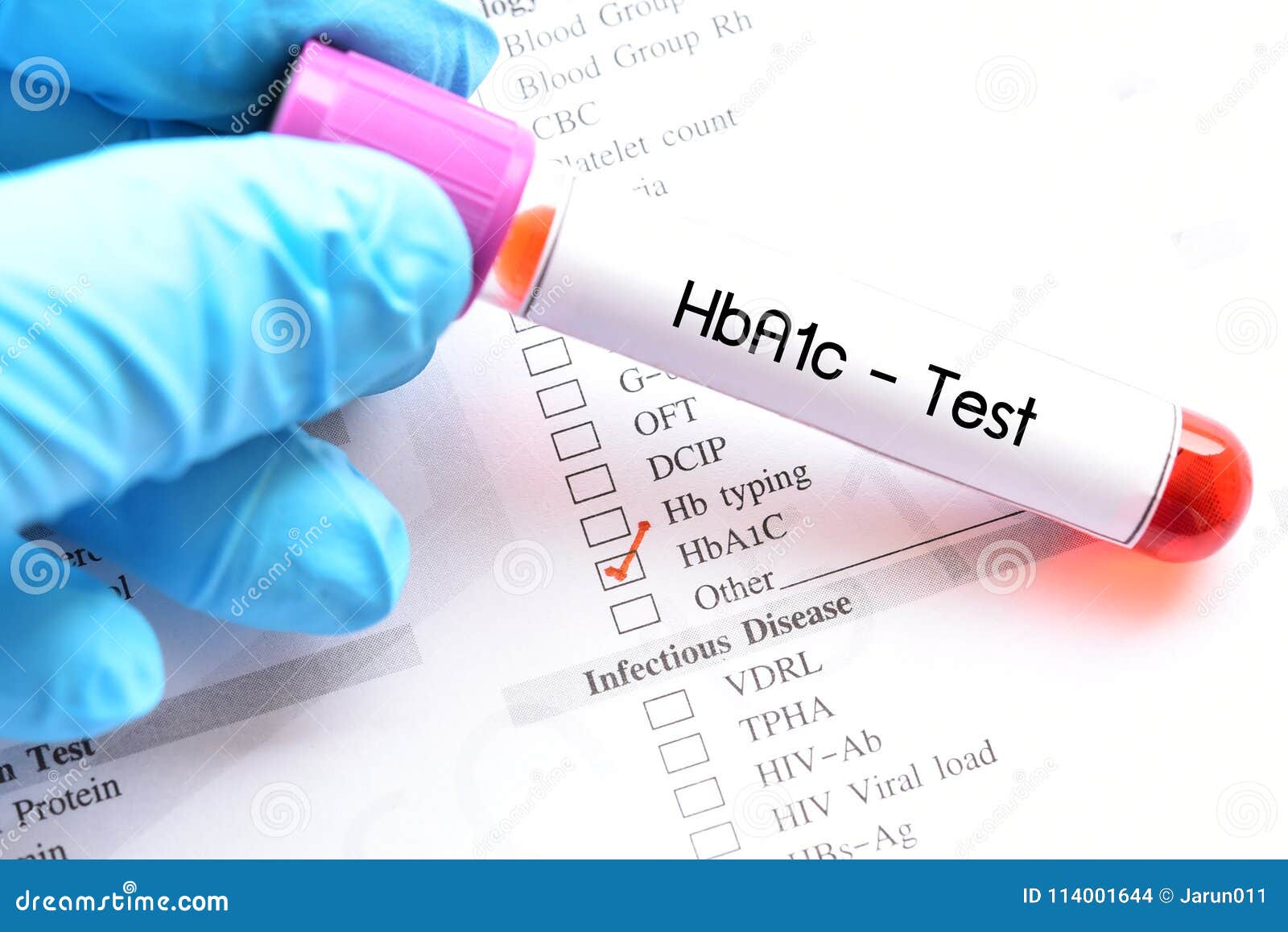 Blood Sample for HbA1c Test Stock Photo Image of medicine, hemoglobin