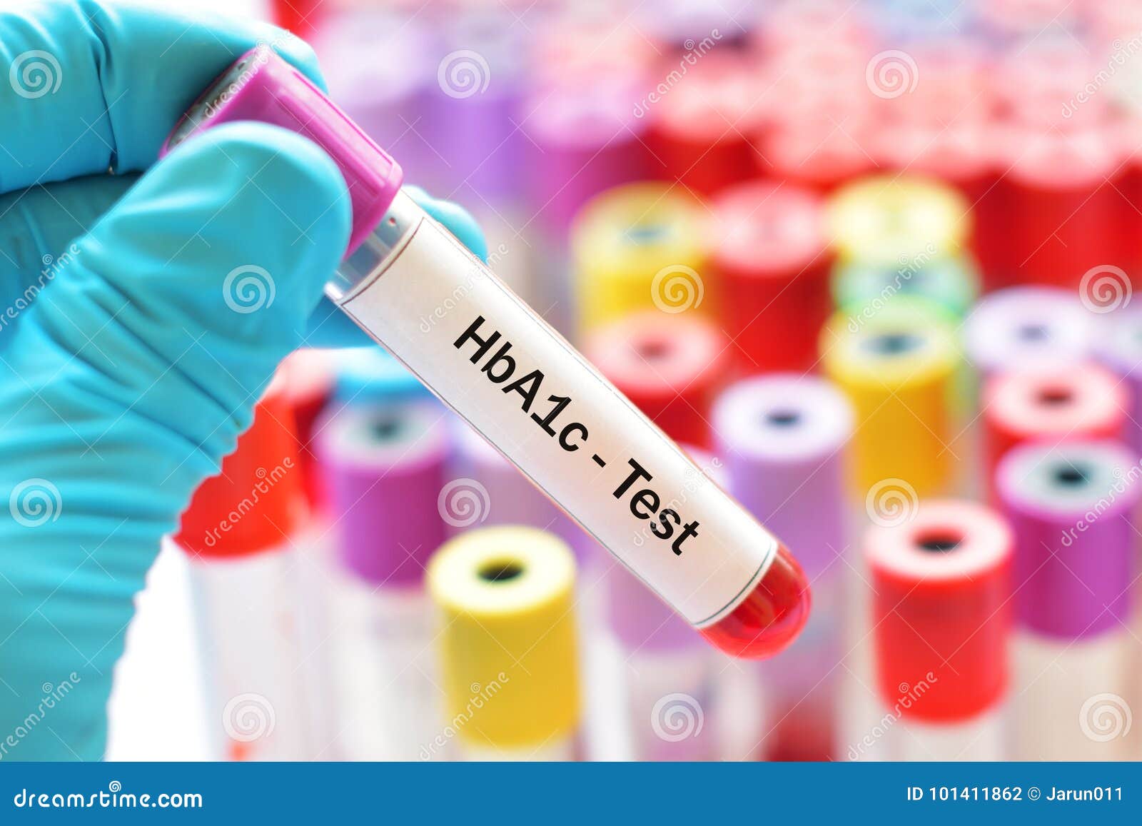 HbA1c test stock photo. Image of checkup, glucose, hospital 101411862
