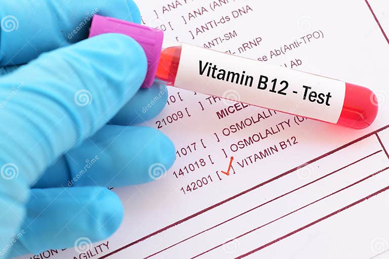 Blood Sample for HBV Viral Load Test Stock Image Image of reaction