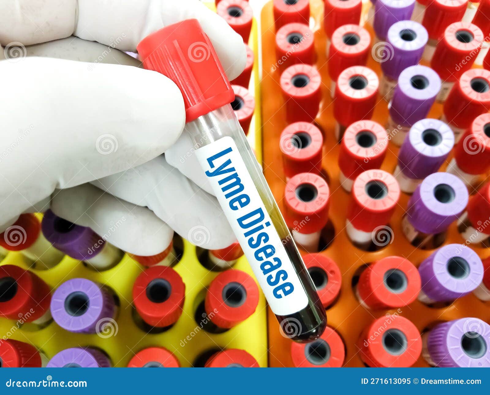 Blood Sample for Lyme Disease Test. Stock Image Image of hospital