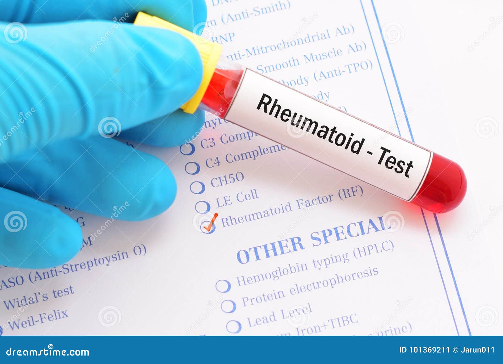 Rheumatoid factor test stock image. Image of chronic 101369211