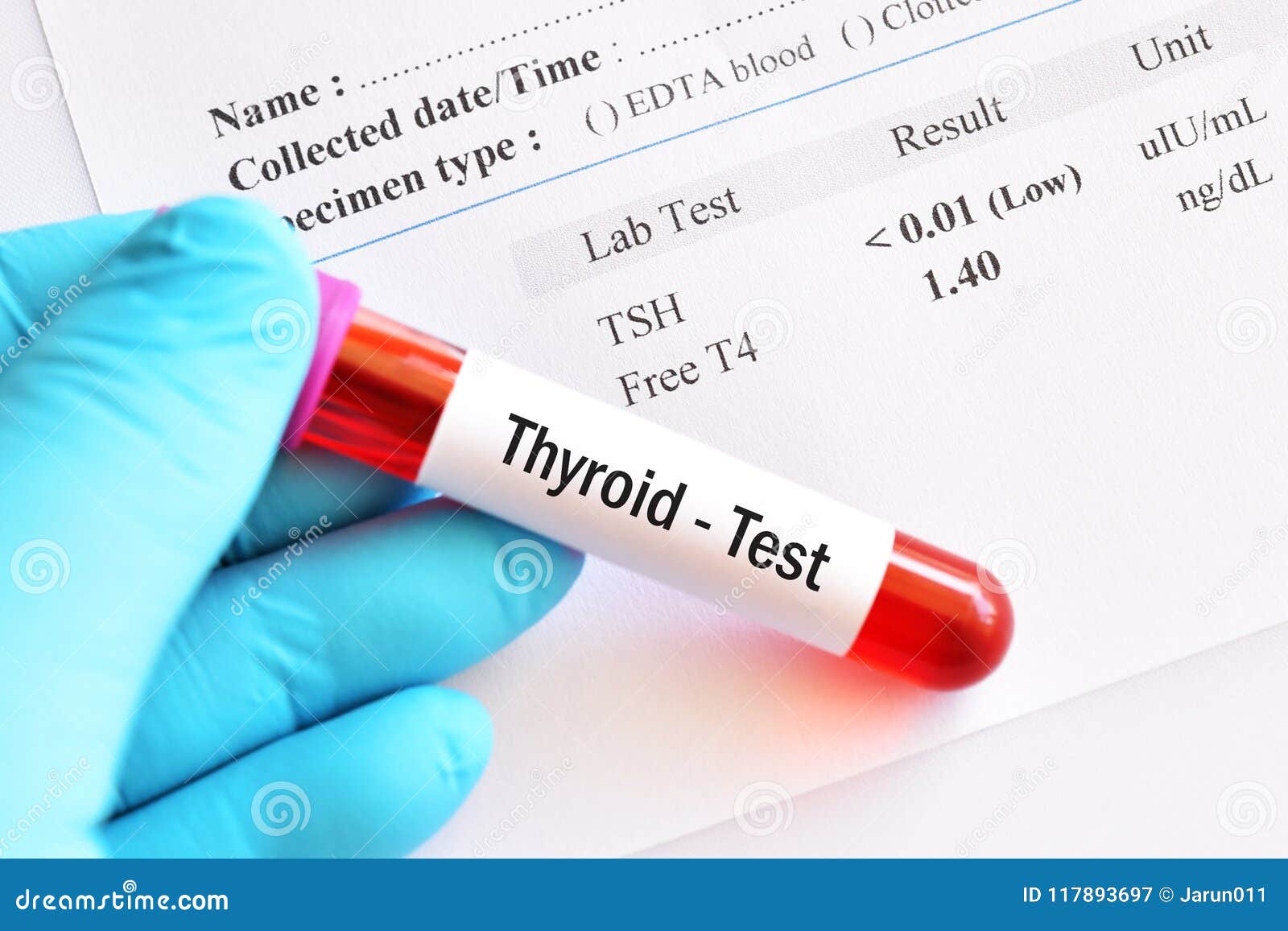 Blood Sample with Thyroid Hormone Result Stock Image Image of iodine