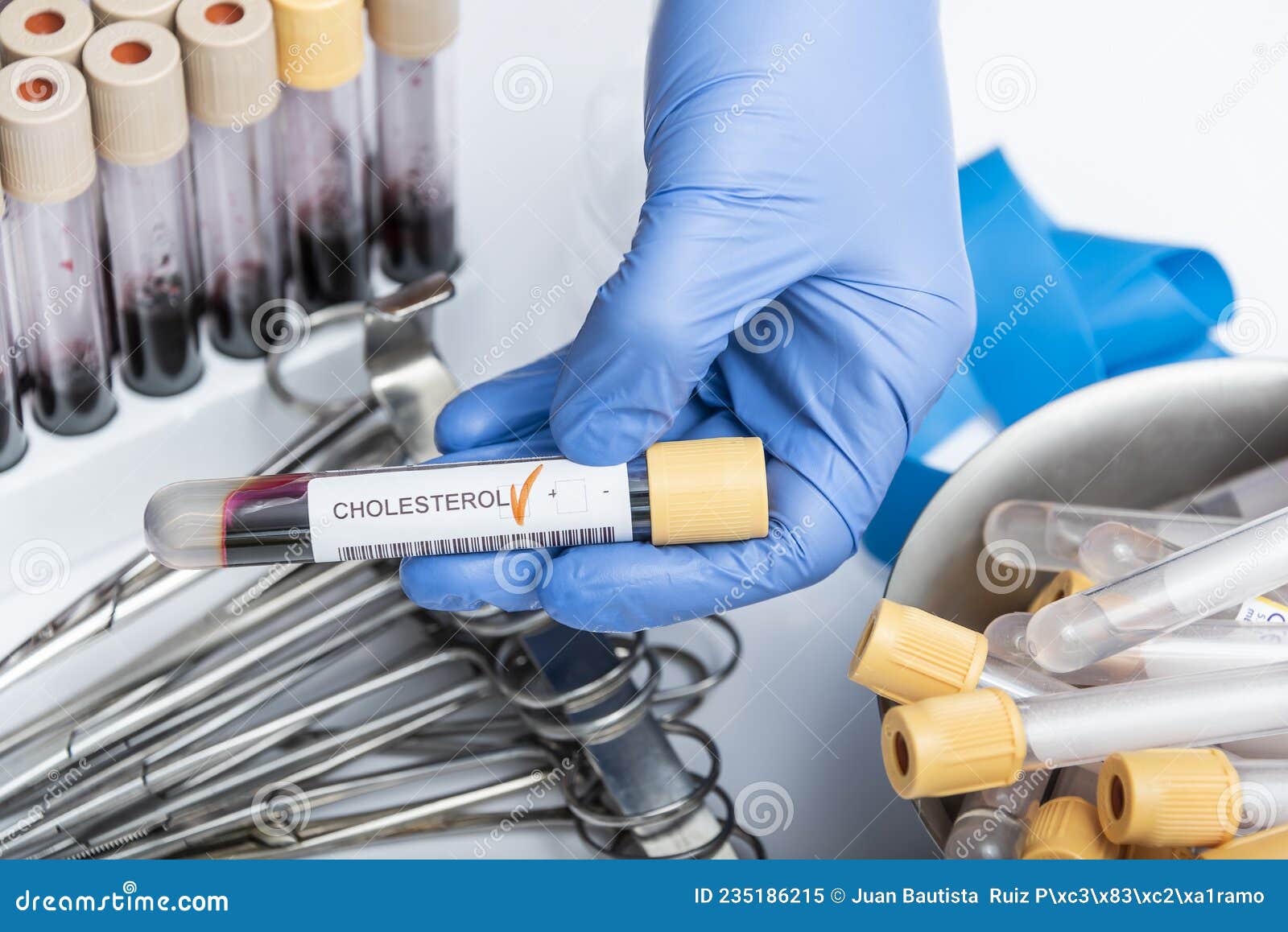 Blood Sample Tube with Abnormal High Cholesterol Test Result. Stock