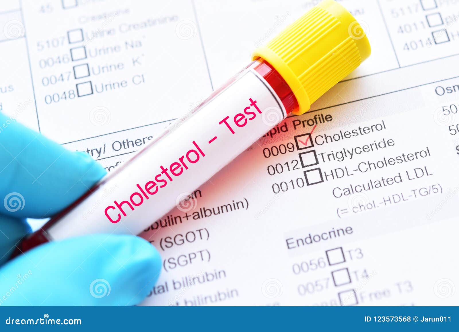 Test tube With Blood Sample For CHOLESTEROL Stock Photography test-tube-with-blood-sample-for-cholesterol-stock-photography
