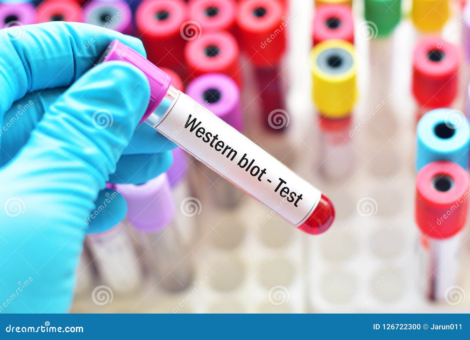western blot hiv confirmatory test cpt code western blot hiv confirmatory test cpt code