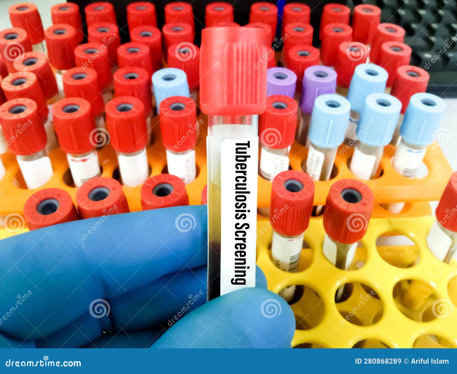 Blood Sample For Tuberculosis Screening Test Stock Image Image Of blood-sample-for-tuberculosis-screening-test-stock-image-image-of