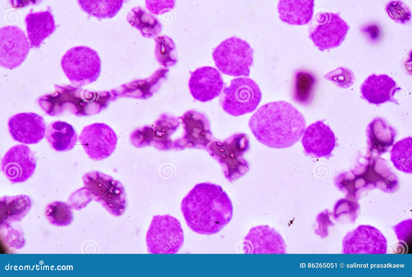 blood smear under microscopy showing on adult acute myeloid leukemia aml is a type of cancer in which the bone marrow makes abn