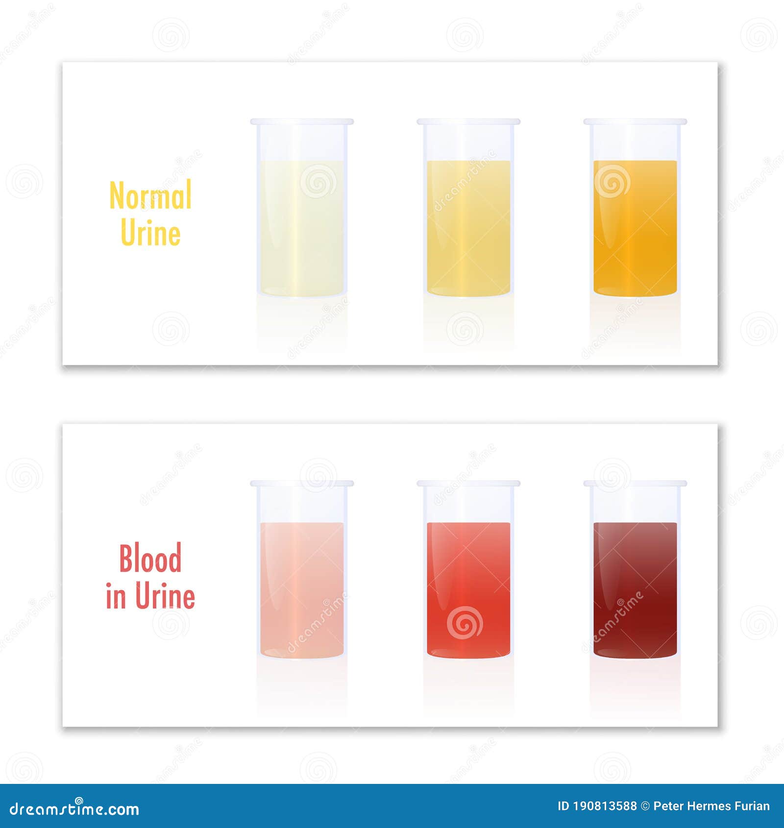 Blood In Urine Color Infographic Chart Yellow Red Stock Vector blood-in-urine-color-infographic-chart-yellow-red-stock-vector