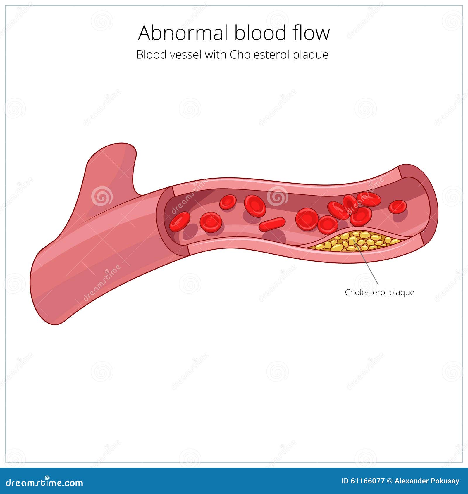 Blood Vessel and Cholesterol Plaque Vector Stock Vector Illustration