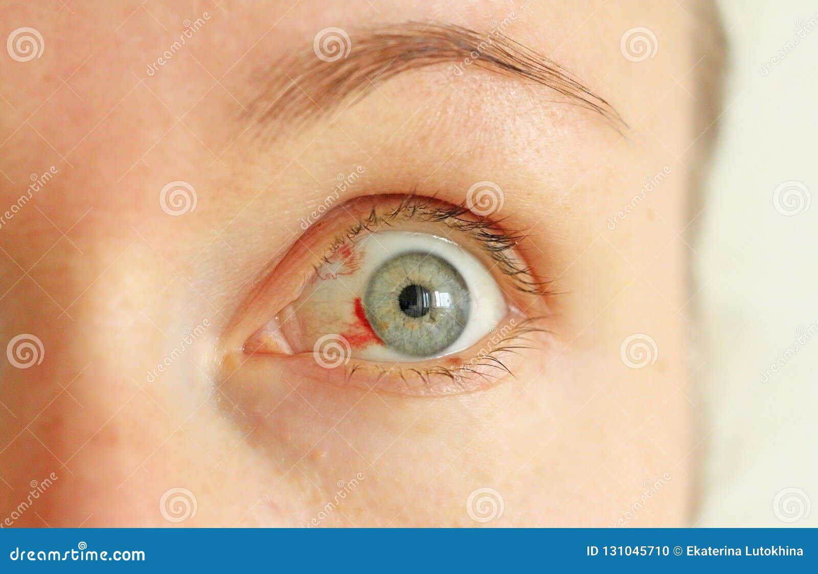 Bloodshot Eye Woman With Burst Blood Vessel In Eye Stock Photo Image