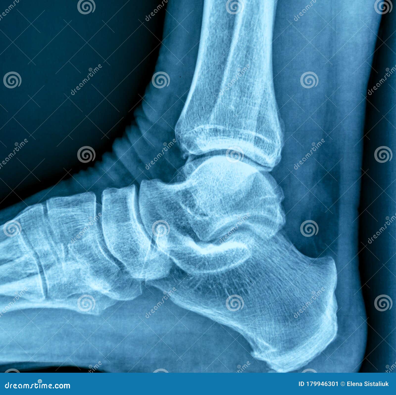 Heel Spur Treatment - Moore Foot & Ankle | Spring, TX