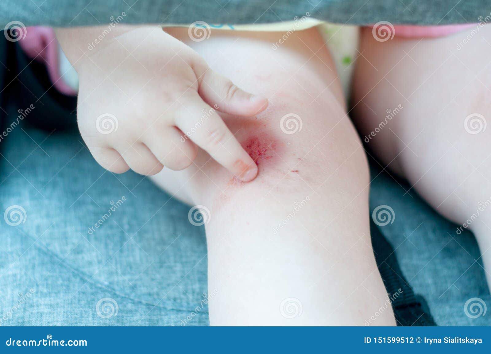 Blur Image Of Fresh Wound On Knee Fresh Bruise Knee Wound Injury With
