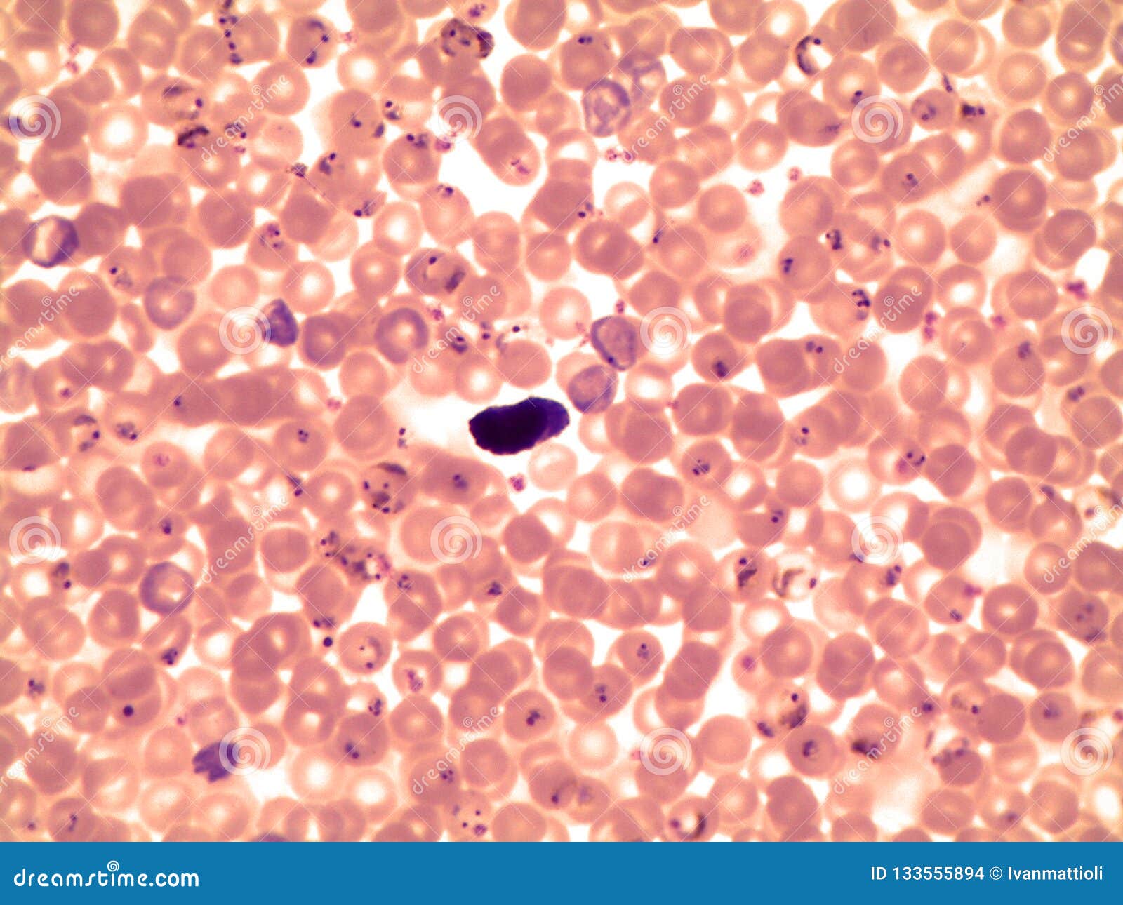 Blutausstrich Eines Patienten Mit Malaria Plasmodium Falciparum Stockfoto Bild Von Blutausstrich Falciparum 133555894