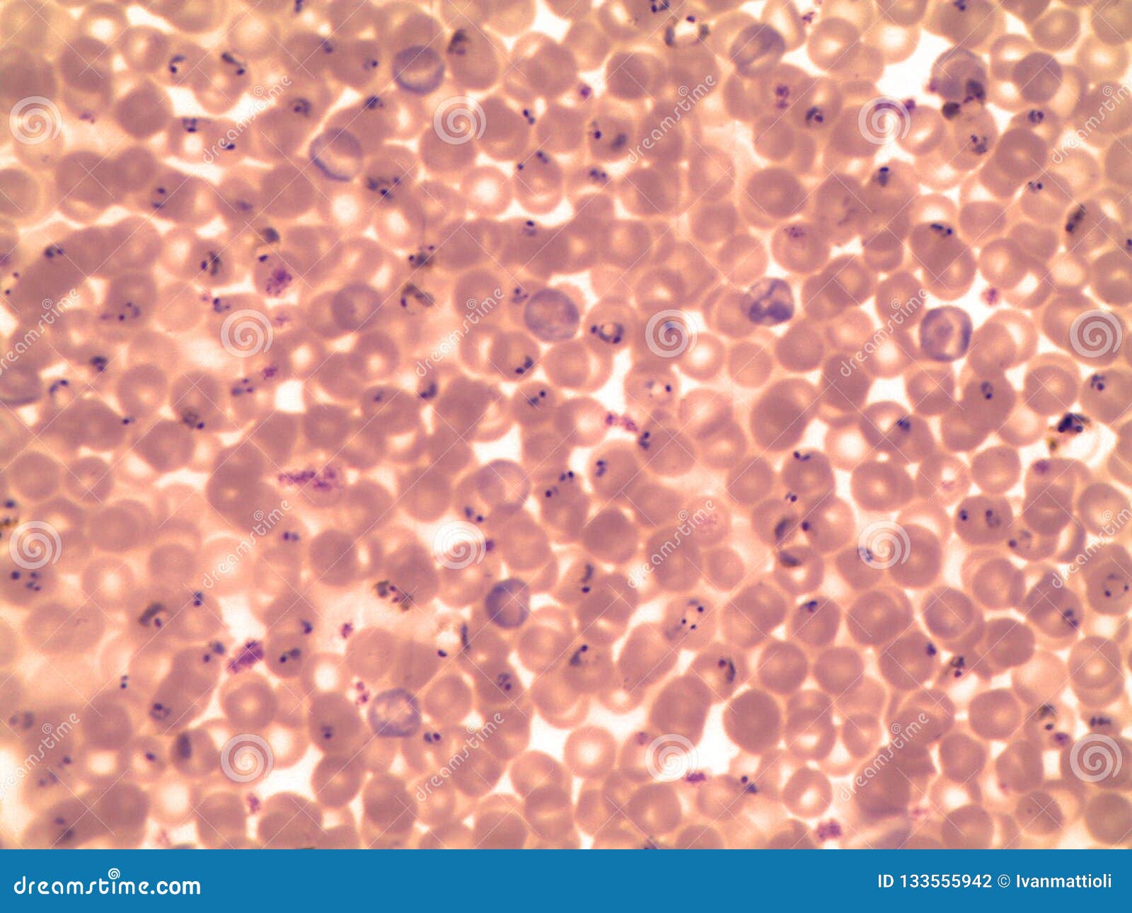 Blutausstrich Eines Patienten Mit Malaria Plasmodium Falciparum Stockfoto Bild Von Falciparum Blutausstrich 133555942