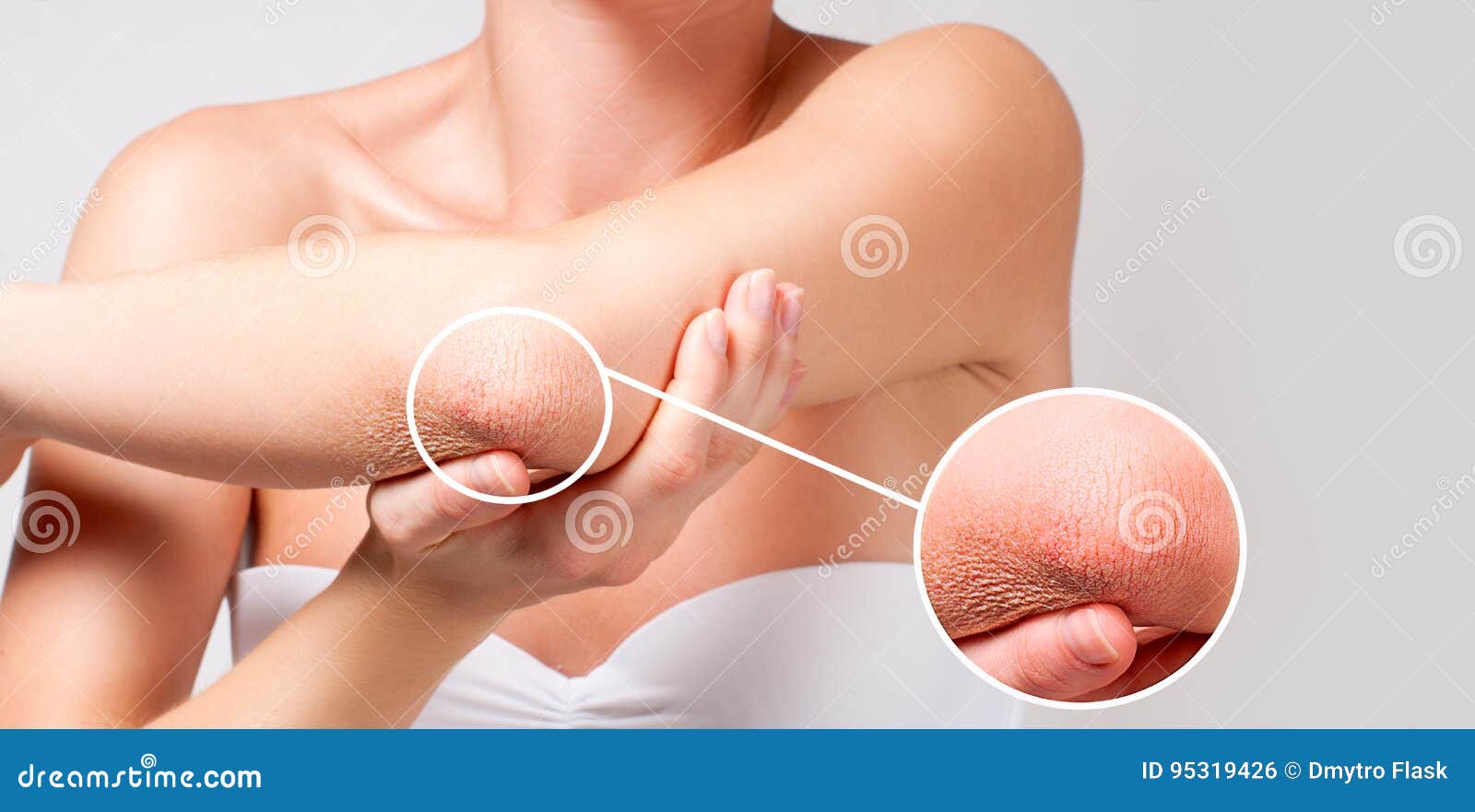 body care. woman has dry skin on elbow.