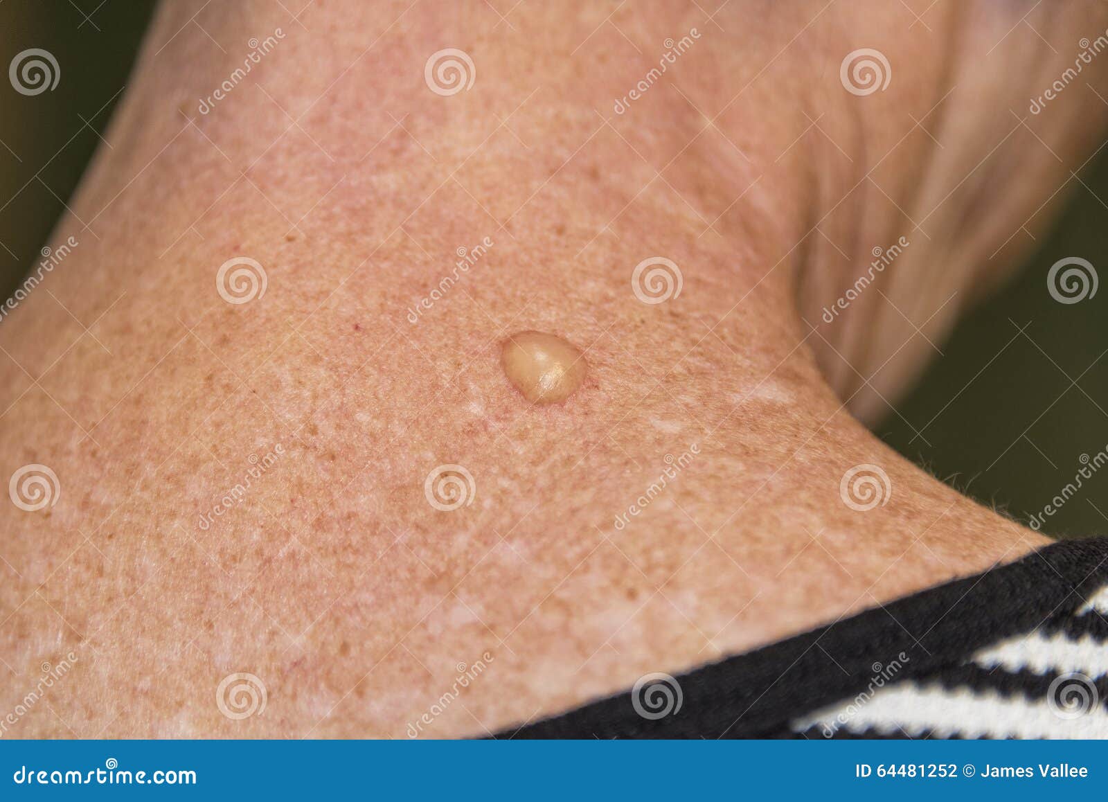 Bolha De Crioterapia Com Nitrogénio Líquido Foto de Stock - Imagem de  câncer, dermatologia: 64481252, image size:1600x1158