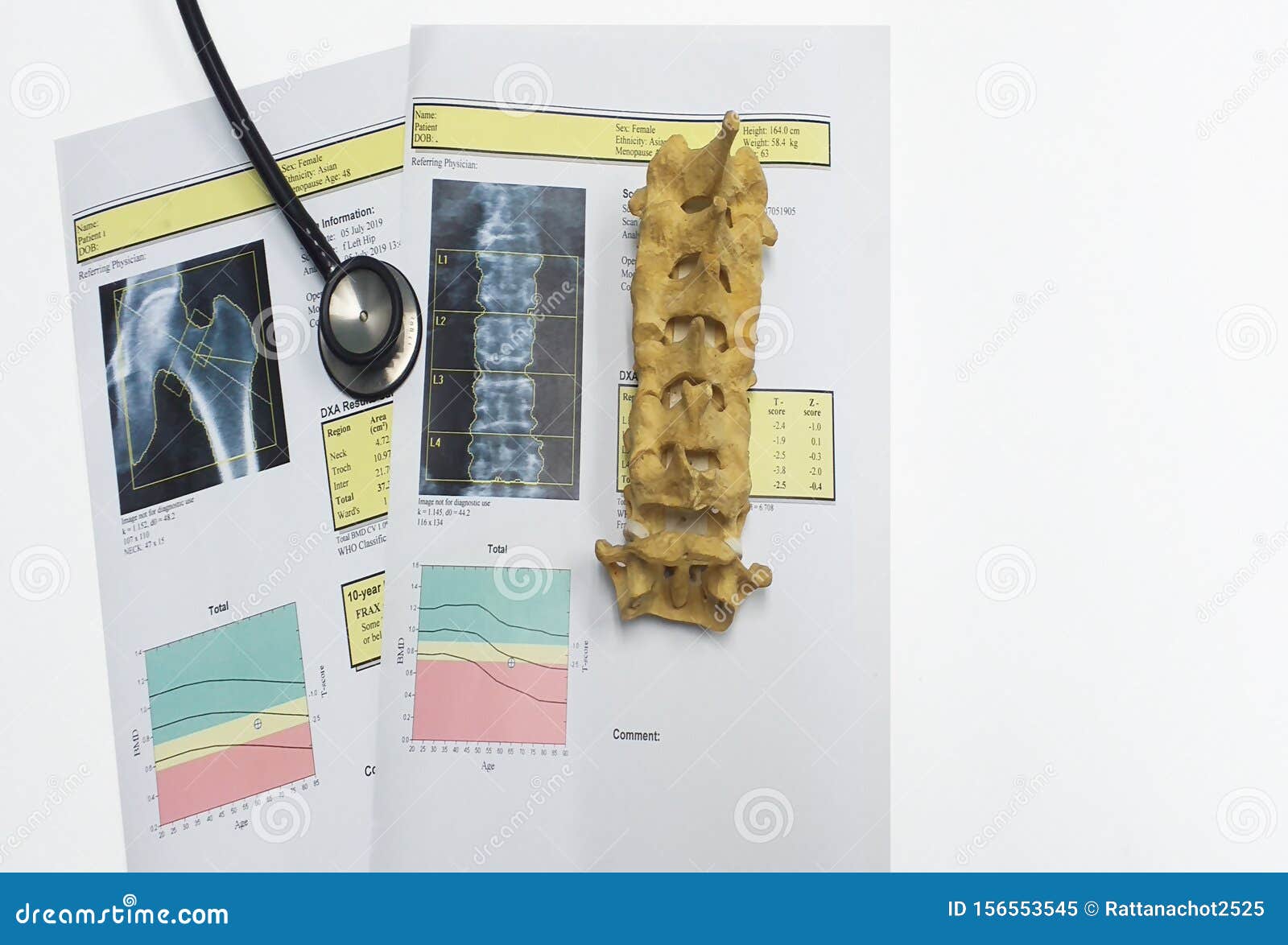 bone density hip and lumbarspine result osteoporosis