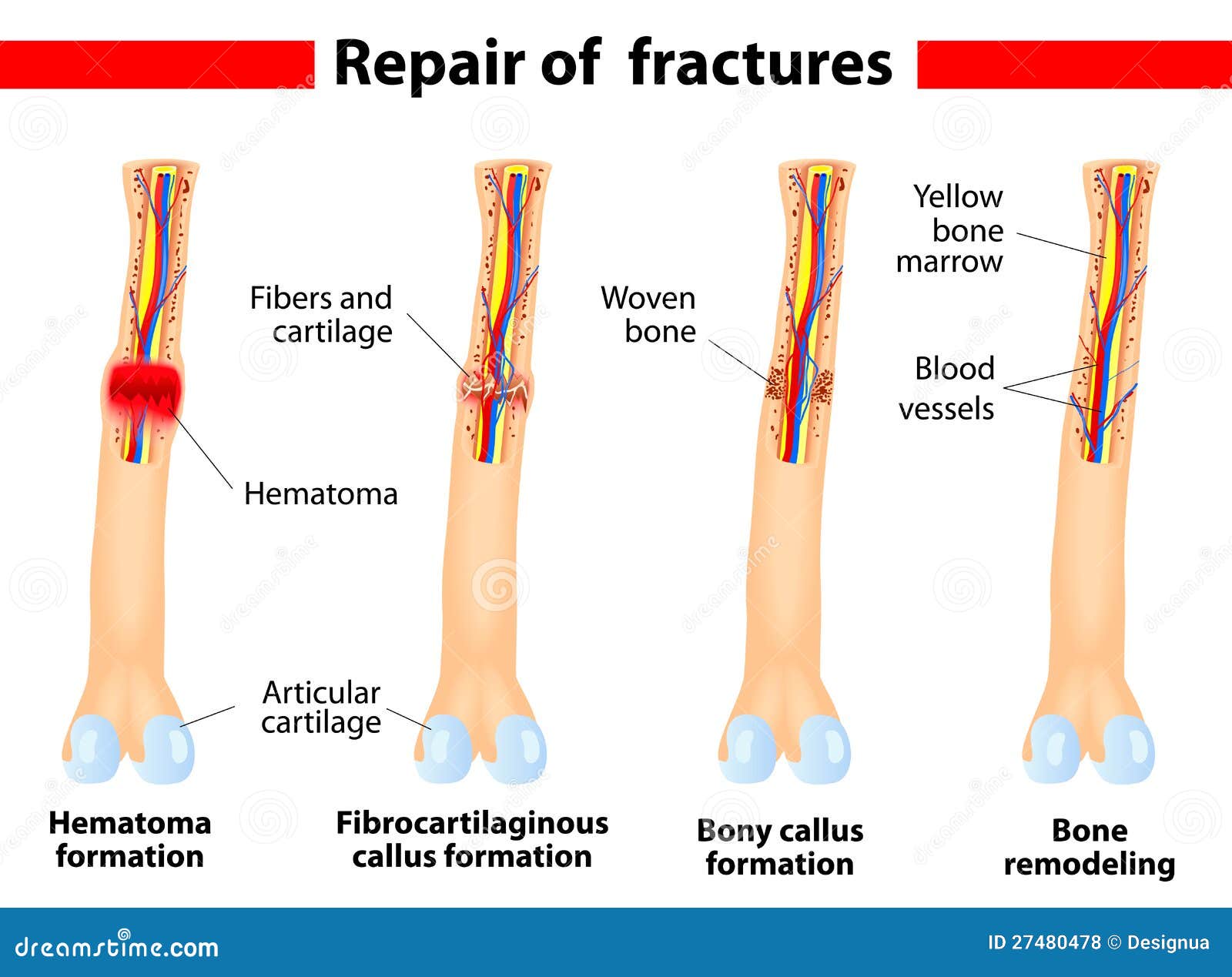 four stages of healing a bone fracture